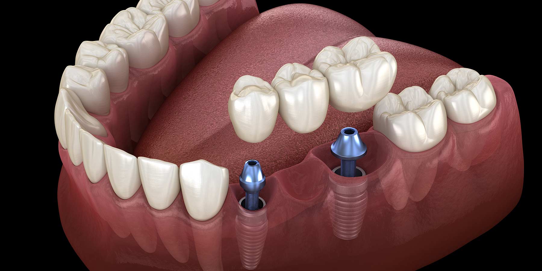 Tooth Replacement - The Advantages of Dental Implants